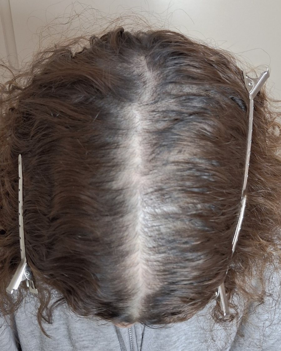 Antes y después de alopecia areata incógnita, tratada por la Dra. Paola Santana